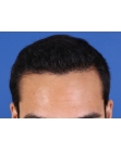 After Hair Transplant&nbsp;Front